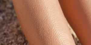 تجربتي الشخصية مع جلد الدجاجة ومسامات البشرة البارزة