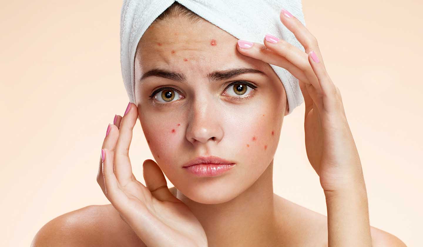 أسباب وعلاجات حب الشباب