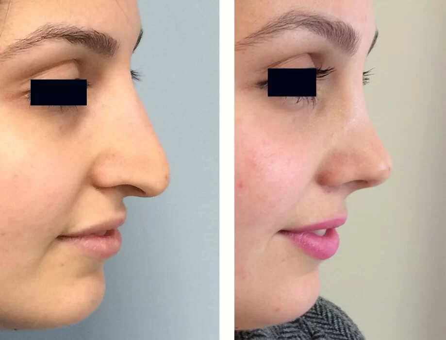 جهاز تقويم الأنف