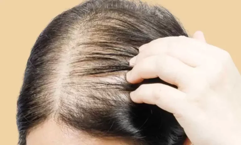 أسباب تساقط الشعر الوراثي