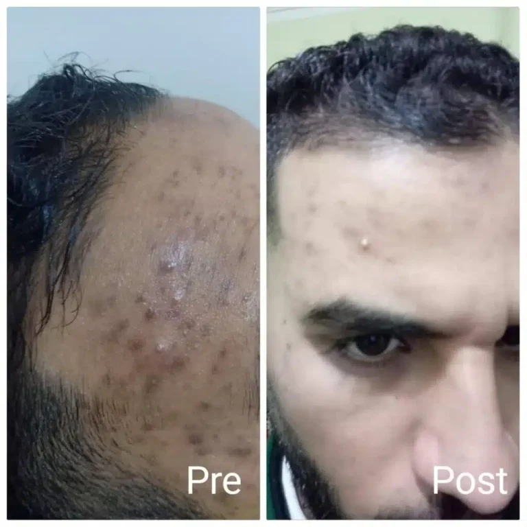 ما هي تقنية الفراكشنال ليزر وكيف تعمل؟